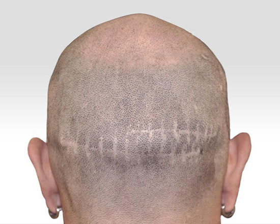 SMP for Hair Transplant Scars